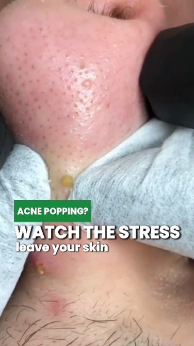 Stressed skin?Â  Breakouts crash the party with redness & irritation. ðŸš¨

VEMONTES Axcne Booster C