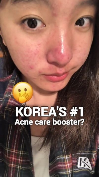 âœ¨ Koreaâ€™s #1 Acne Booster has arrived!

Meet the Vemontes Axcne Booster â€” your skinâ€™s new se