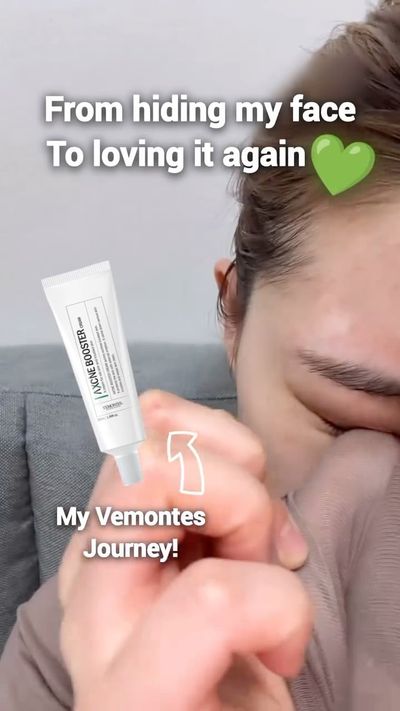 My Vemontes Acne-healing JourneyðŸ’š
Even though it hasnâ€™t been on the market for long, itâ€™s alr