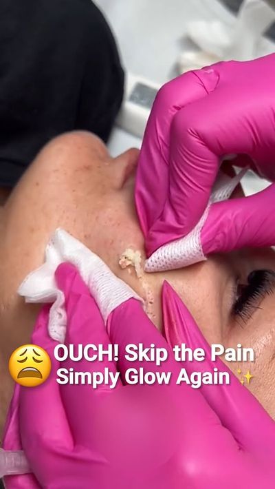 ðŸ˜± OMG! Painful acne treatments? Why put your skin through that? ðŸ©¹âœ¨ Flawless skin shouldnâ€™t