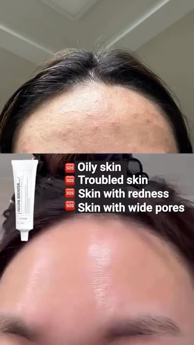 Meet the upgraded Vemontes Axcne Booster Cream âœ¨

This new formula works on contact to soothe infl
