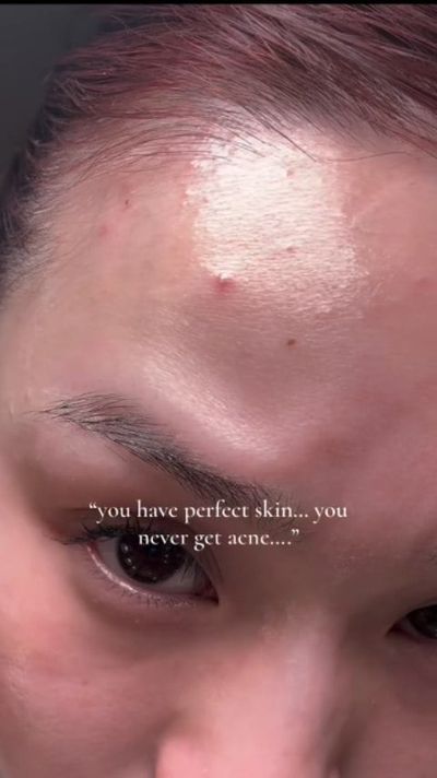 Using AXCNE Booster Cream â€” my skinâ€™s new acne-fighting BFF ðŸ’š

Smooth texture, zero stickines