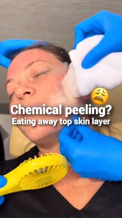 â€œChemical peeling? Eating away the top skin layer? ðŸ˜³ðŸ« 
I used to think thatâ€™s the only shor