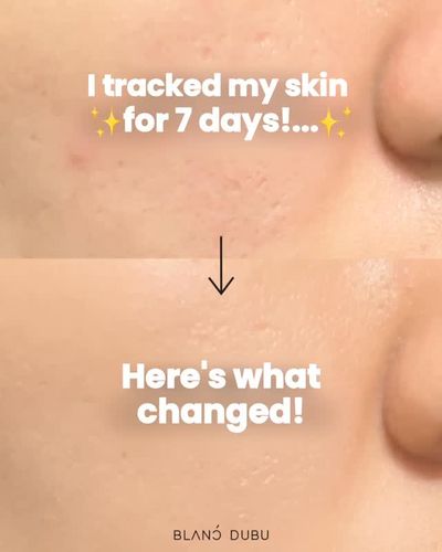Idebenone that penetrates deeper into the skin and roots out even deep-seated dark spots and pigment