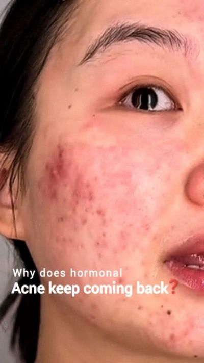 ðŸ’” Hormonal acneâ€¦ sometimes I feel bad for the little girl inside me having to go through this.

