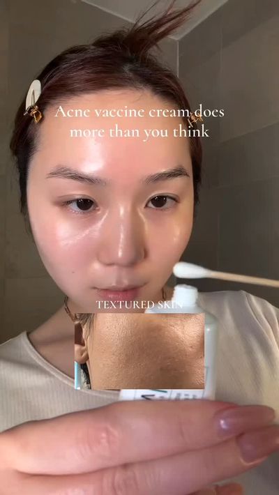 Acne vaccine cream does more than you think!ðŸ’¥ Itâ€™s not just a cream â€” itâ€™s a skin re-traine