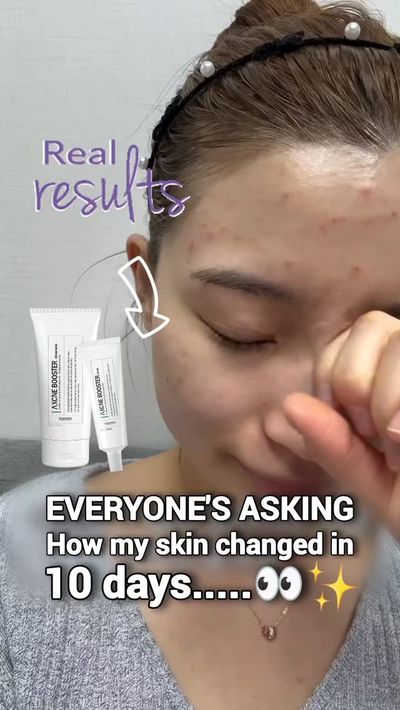 If you saw her skin last weekâ€¦ you wouldnâ€™t believe this is her now. ðŸ¤¯âœ¨

Hereâ€™s what actu